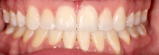 Before and after image of a smile transformation showing straightened teeth after orthodontic treatment at Bliss Orthodontics, highlighting braces and Invisalign results for patients in Flower Mound, TX.