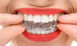 Invisalign Clear Aligners Coppell TX - Teeth Straightening